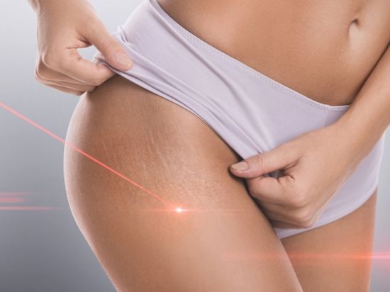 How To Get Rid Of Stretch Marks – Surgery